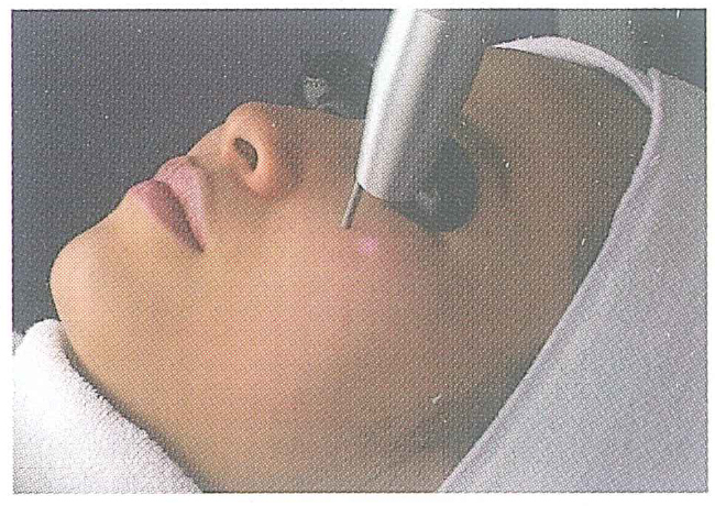 レーザートーニング