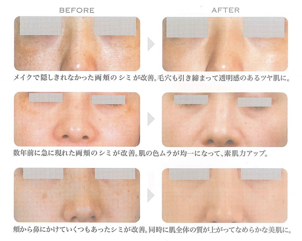 レーザートーニングの効果